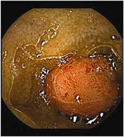 Capsule Endoscopy in Children